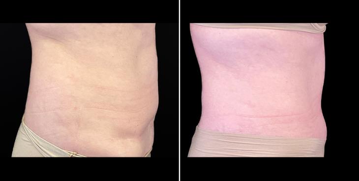 Tummy Tuck Results Alpharetta Right Side View