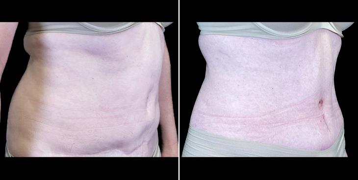 Tummy Tuck Results Alpharetta ¾ Right View