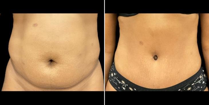 Before & After Tummy Tuck Alpharetta