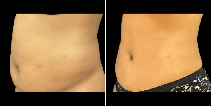 Before & After Tummy Tuck Alpharetta ¾ Left View