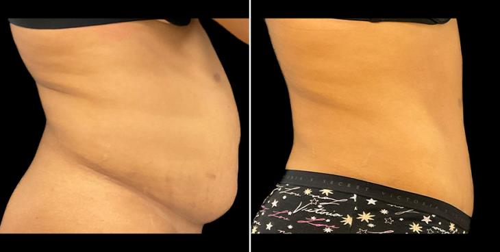 Before & After Tummy Tuck Alpharetta Right Side View