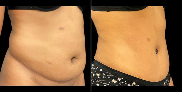 Before & After Tummy Tuck Alpharetta ¾ Right View