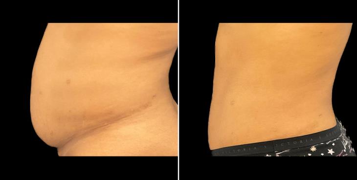 Before & After Tummy Tuck Alpharetta Left Side View