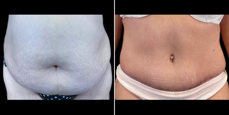 Before & After Alpharetta Tummy Tuck