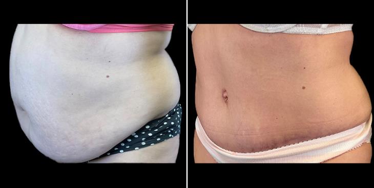 Before & After Alpharetta Tummy Tuck ¾ Left View