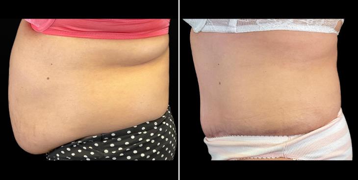 Before & After Alpharetta Tummy Tuck Left Side View