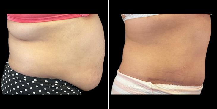 Before & After Alpharetta Tummy Tuck Right Side View