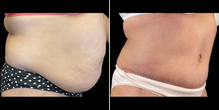 Before & After Alpharetta Tummy Tuck ¾ Right View