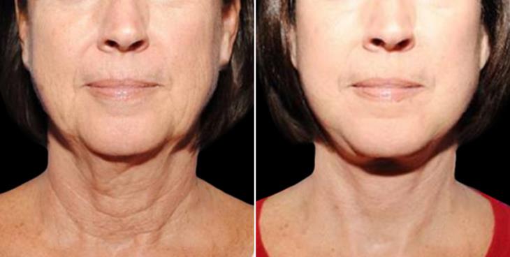 Before & After Neck Lift