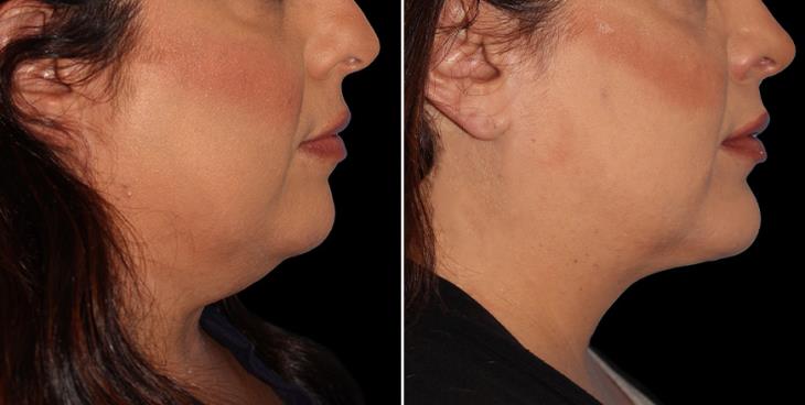 R Neck Lift