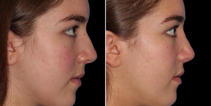 Rhinoplasty Before And After Cumming GA