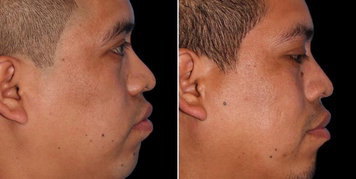 Before And After Rhinoplasty Surgery Cumming GA