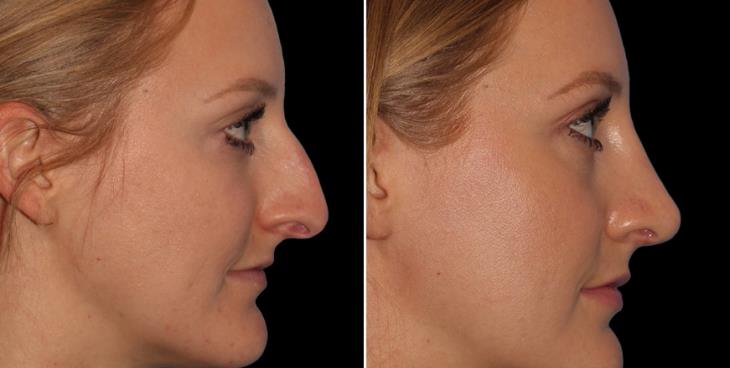 Rhinoplasty Surgery Before And After Cumming GA