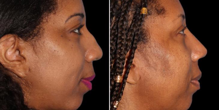 Before And After Rhinoplasty Cumming Georgia