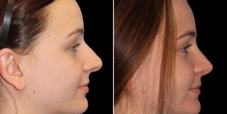 Rhinoplasty Surgery Before And After Cumming Georgia