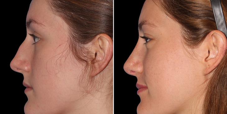 Results Of Nose Surgery Marietta