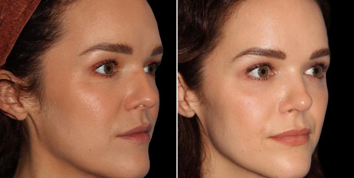 Before & After Nose Surgery Marietta