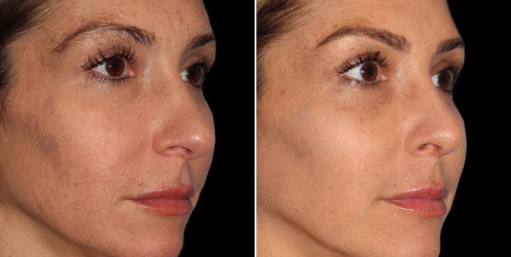 Before And After Rhinoplasty Alpharetta