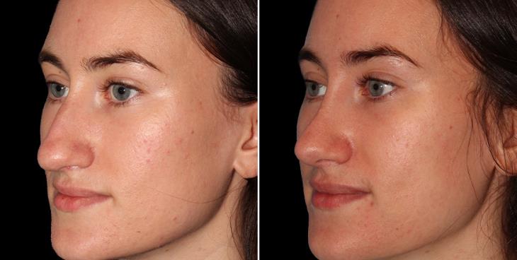 Rhinoplasty Surgery Before And After Alpharetta