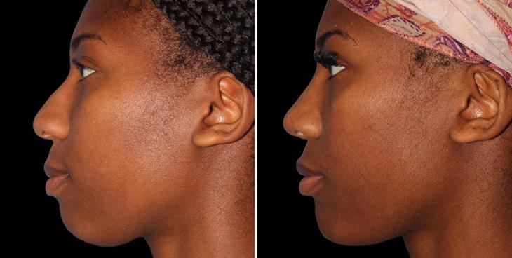 Before & After Nose Surgery Alpharetta