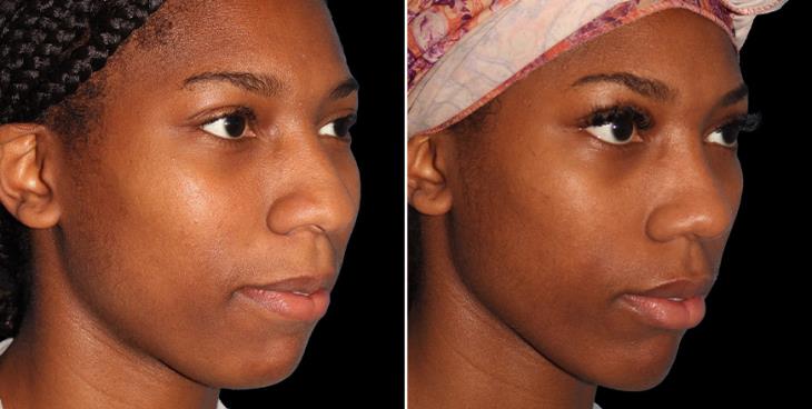 Nose Surgery Before & After Alpharetta
