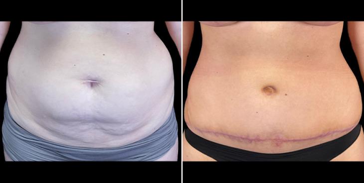 Before & After Tummy Tuck Surgery In Alpharetta