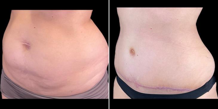 Before & After Tummy Tuck Surgery In Alpharetta ¾ Left View