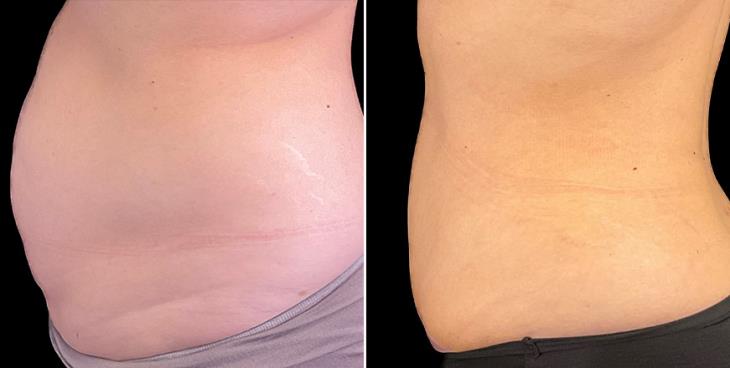 Before & After Tummy Tuck Surgery In Alpharetta Left View