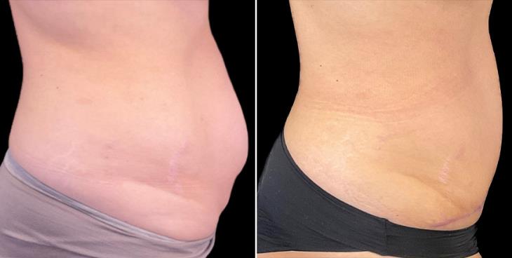 Before & After Tummy Tuck Surgery In Alpharetta Right View