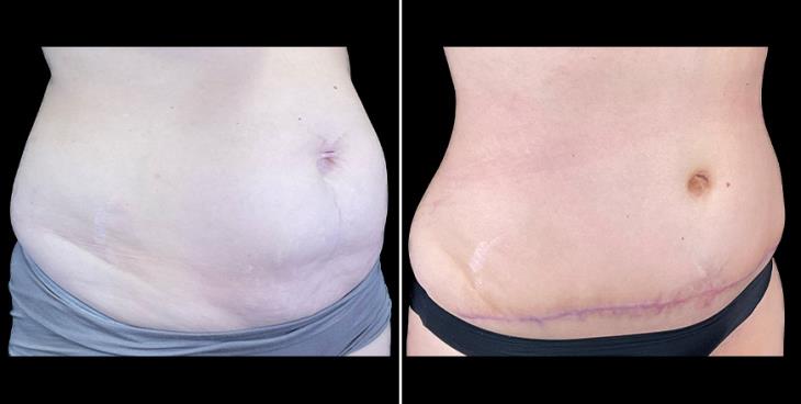 Before & After Tummy Tuck Surgery In Alpharetta ¾ Right View