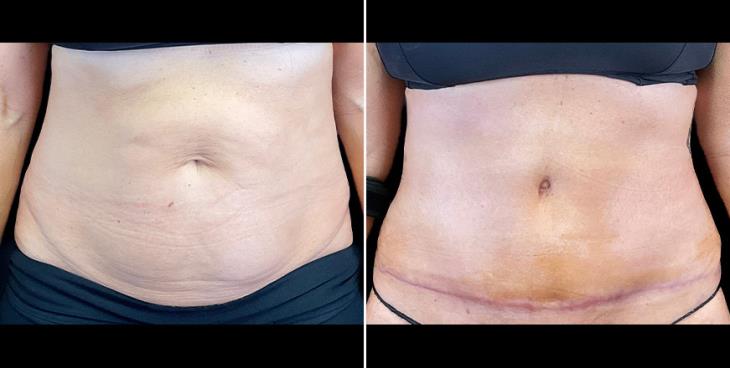 Before & After Tummy Tuck Surgery Alpharetta