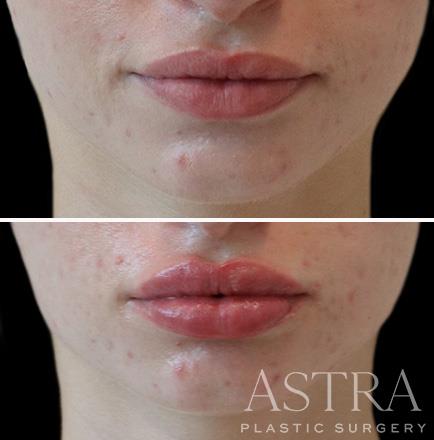 Before & After Lip Injections Atlanta GA