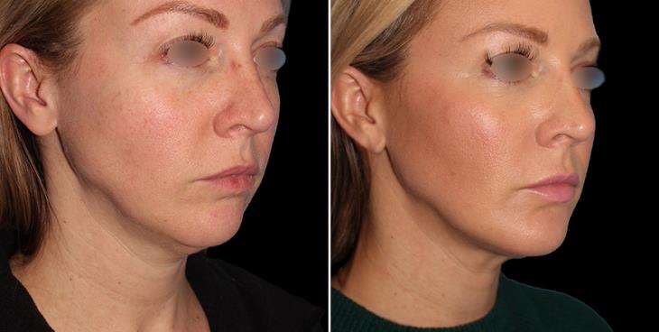 Before & After Facial Lipo Atlanta ¾ Right View