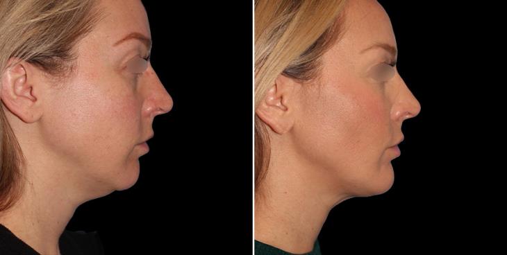 Before & After Facial Lipo Atlanta Right Side View