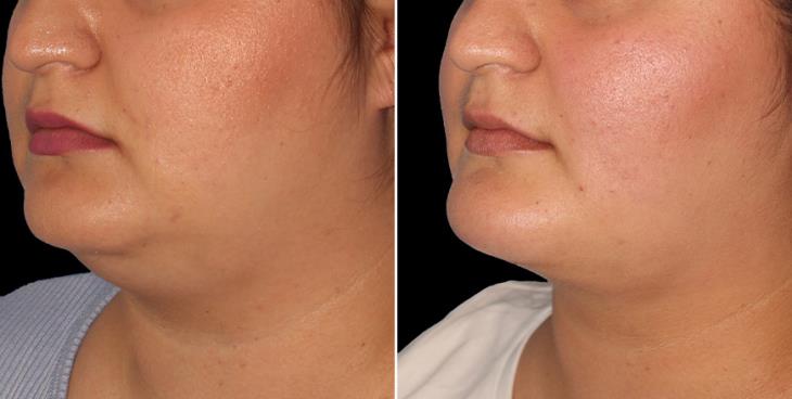 Chin Augmentation Before & After ¾ Left View