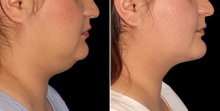 Chin Augmentation Before & After Right Side View