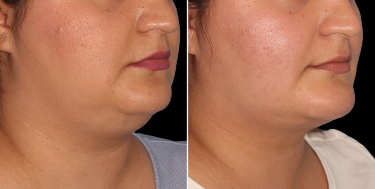 Chin Augmentation Before & After ¾ Right View