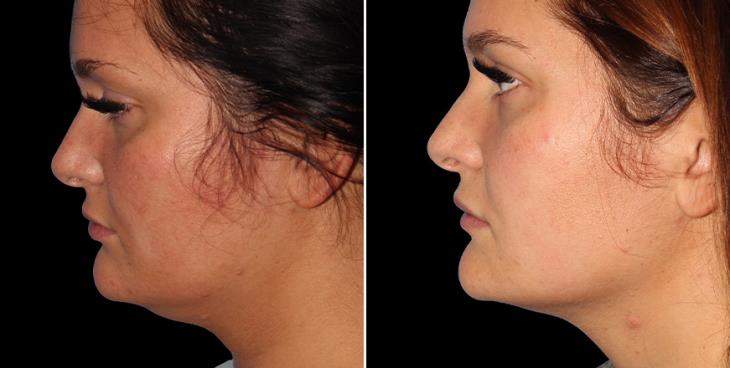 Before & After Facial Lipo Left Side View