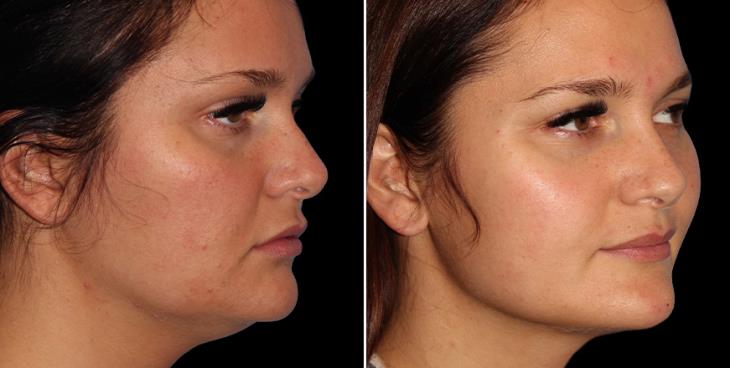 Before & After Facial Lipo ¾ Right View