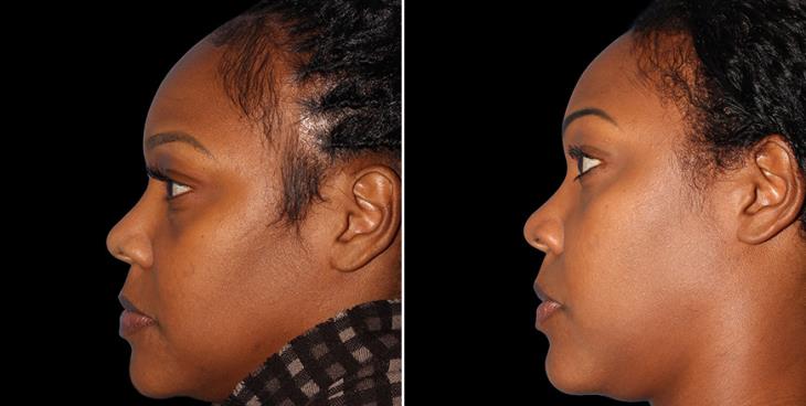 Forehead Reduction Before & After Atlanta Left Side View