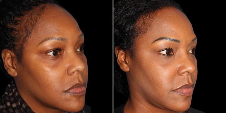 Forehead Reduction Before & After Atlanta ¾ Right View