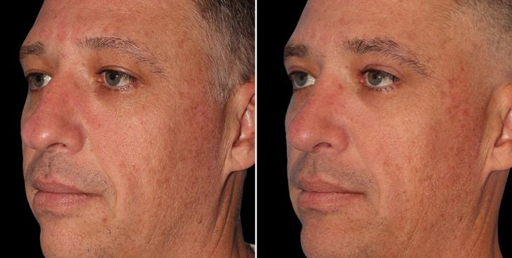 Before And After Rhinoplasty Alpharetta GA