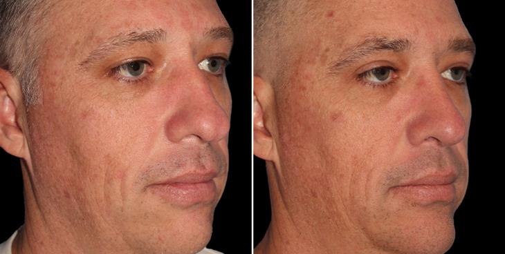 Before & After Rhinoplasty Surgery Alpharetta GA