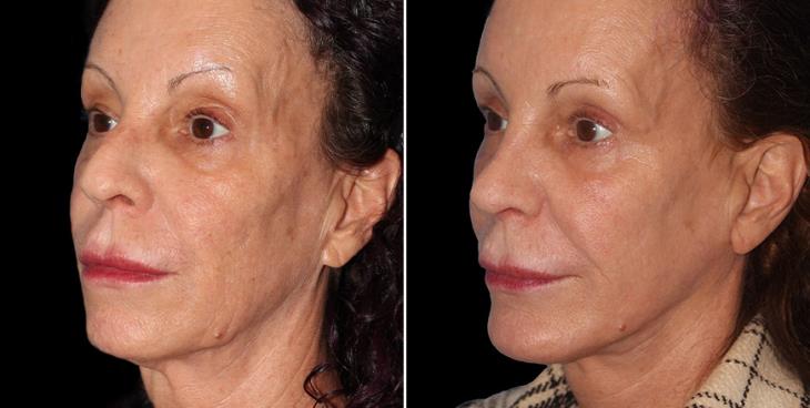 Nose Surgery Before And After Alpharetta GA