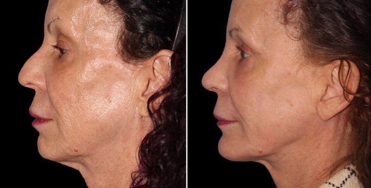 Facelift Surgery Results In Atlanta Left Side View