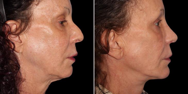 Facelift Surgery Results In Atlanta Right Side View