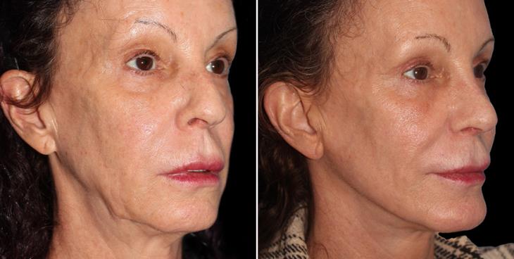 Laser Skin Resurfacing Results ¾ Right View