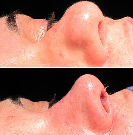 Rhinoplasty Surgery Before & After In Atlanta