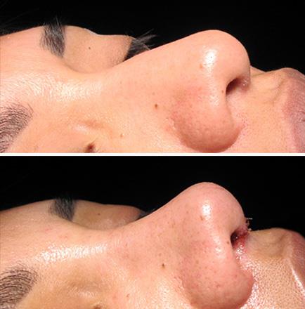 Results Of Rhinoplasty In Atlanta GA