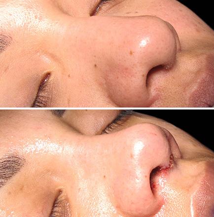 Rhinoplasty Surgery Results In Atlanta GA